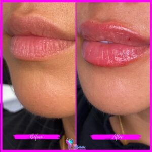 where to get lip filler in cypress