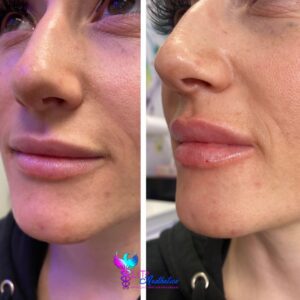 lip filler in cypress tx