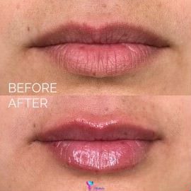 lip injections in cypress