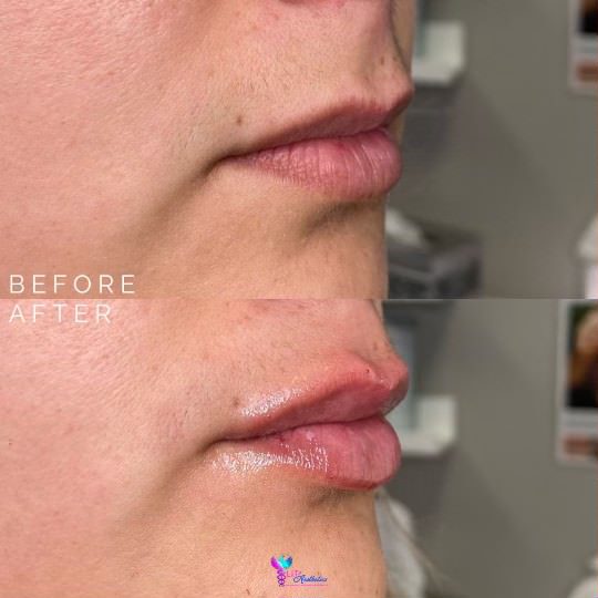 lip injections cypress tx