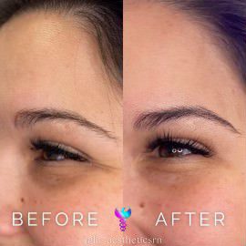 Before and after using the neurotoxin dysport for eye wrinkles