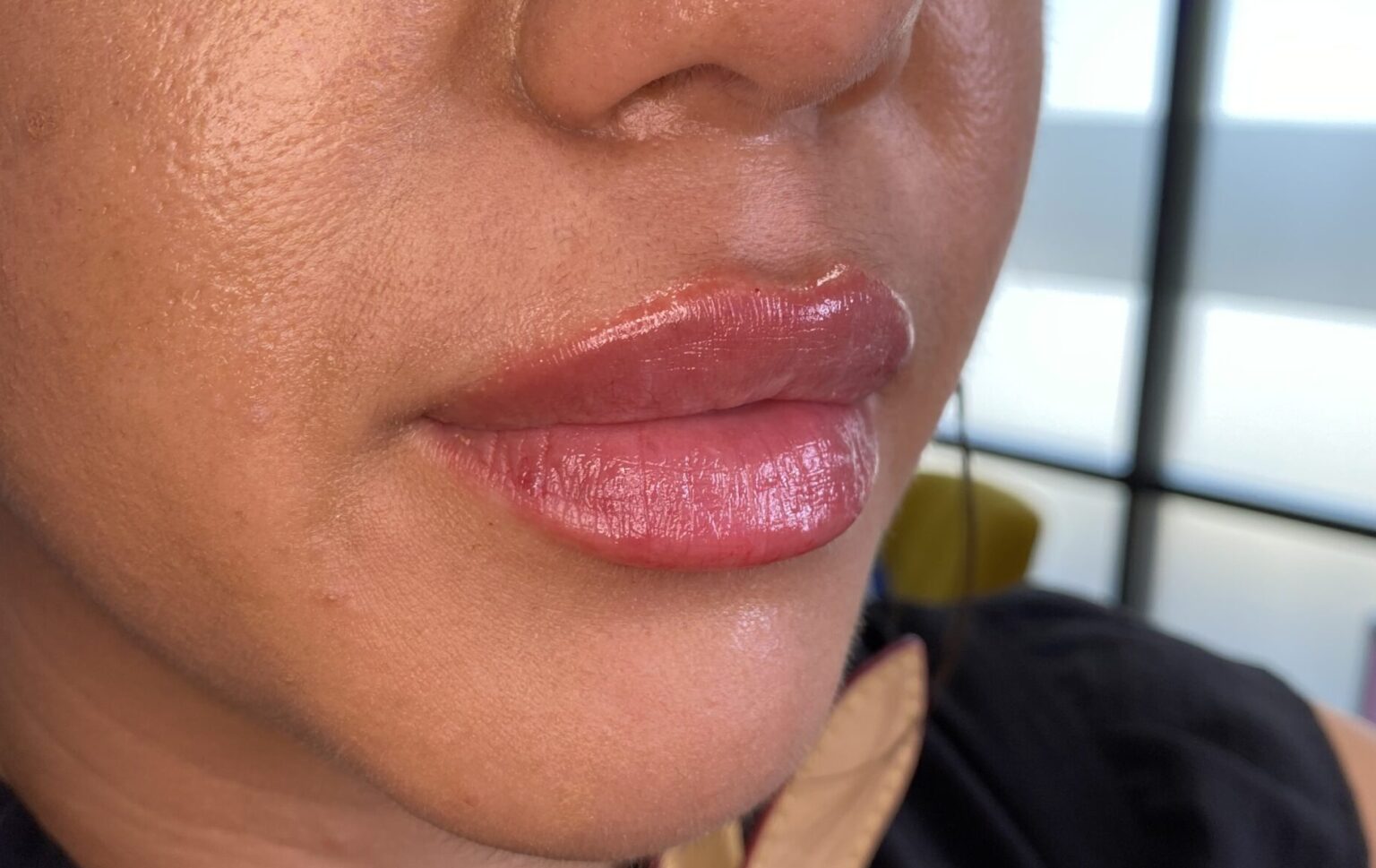 lip augmentation cypress tx