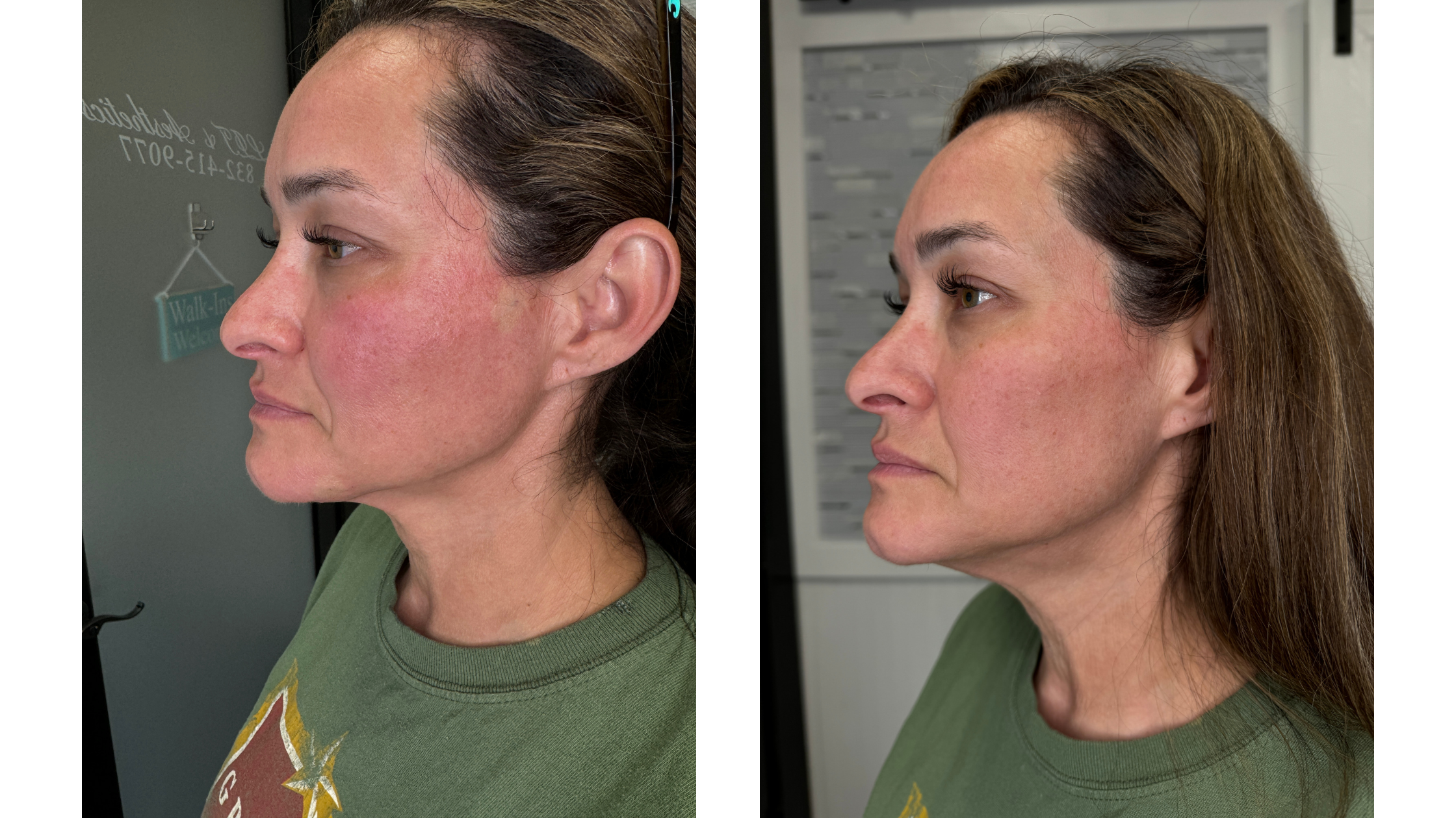 Before and After Jawline Filler for Jowling