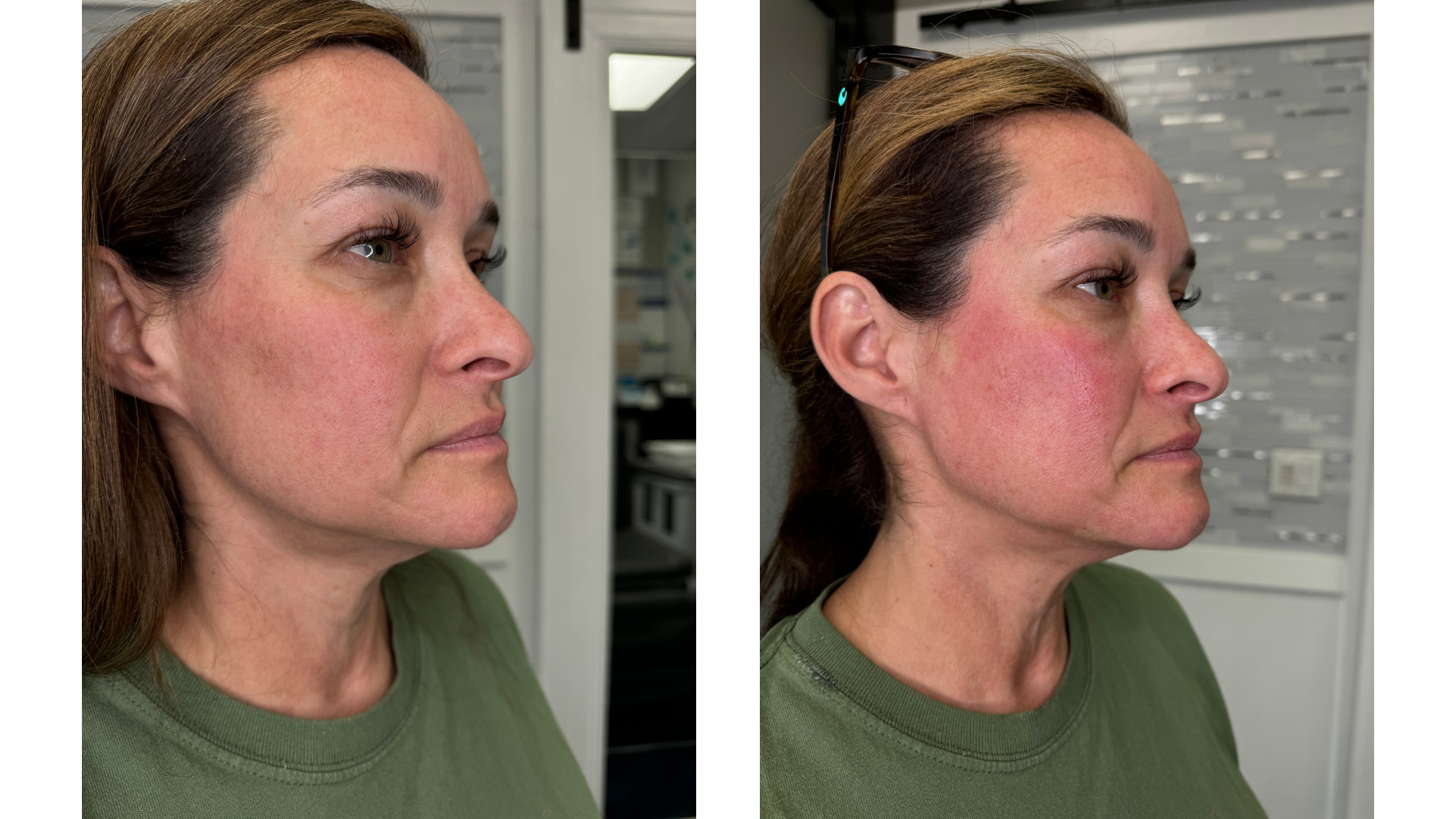 Before and After Sculptra for Jowls