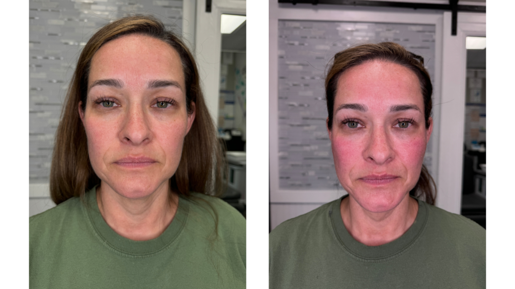 before and after sculptra treatments