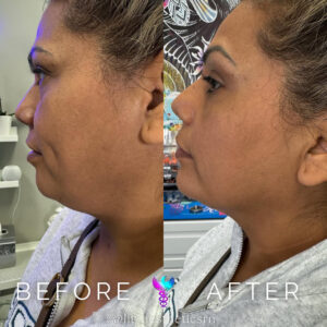 Before and After Jawline Filler in Cypress at LIT Aesthetics