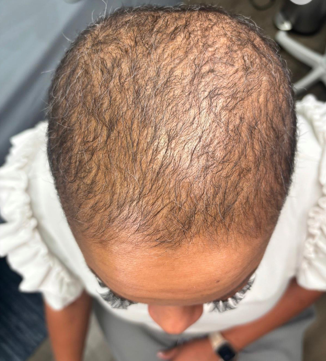Hair restoration before image