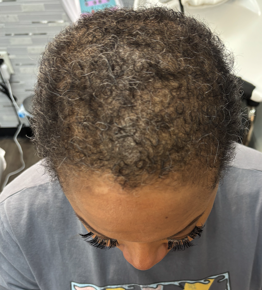 Hair restoration after image